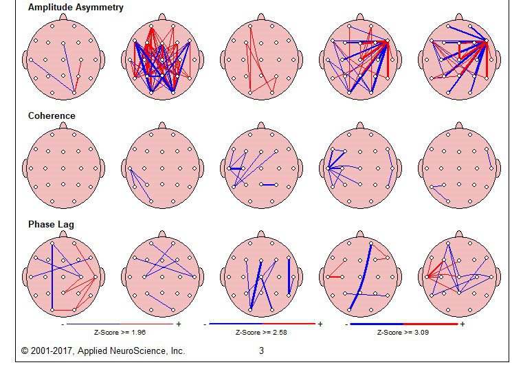 روابط نقاط مغز توسط دستگاه نقشه مغزی ( QEEG )